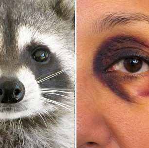 Atenção aos olhos de guaxinim: eles surgiram do nada em mulher de 60 anos e revelaram uma doença rara que pode comprometer o coração e os rins
