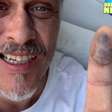 Guilherme Fontes mostra dedo roxo após picada de cobra: 'Não sinto nada'