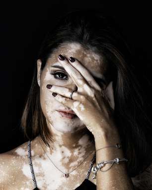 Vitiligo: Entenda o que é essa doença