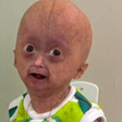 O que é a 'síndrome de Benjamin Button', que vitimou gêmea aos 5 anos em Roraima