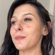 De rosto limpo, Ana Castela desabafa sobre luta contra acne grave