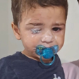 Bebê vai parar no hospital após grudar o próprio olho com Super Bonder em SC