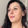 De rosto limpo, Ana Castela desabafa sobre luta contra acne grave