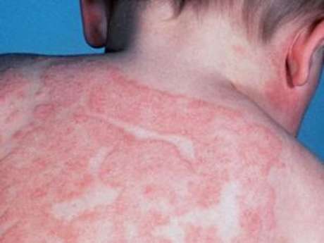 El tratamiento de la psoriasis en moskve en el instituto