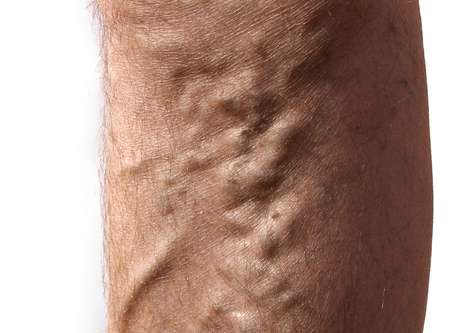 Thinkstock <p>Las várices son una dilatación venosa que con frecuencia aparecen en las piernas.</p>