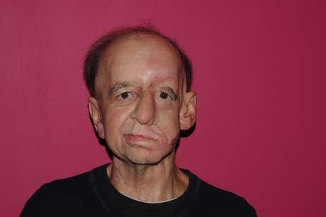 Eric Moger recebeu prótese facial para cobrir depressão causada por um tumor maligno <p>Eric Moger recebeu prótese facial para cobrir depressão causada por um tumor maligno</p>