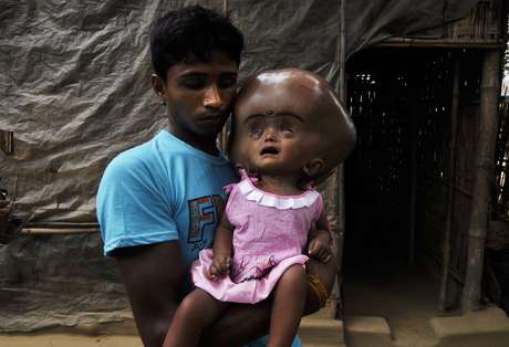 A menina de 18 meses sofre de hidrocefalia, uma doença rara que é definida pelo aumento do volume do espaço contendo fluido cerebrospinal <p>A menina de 18 meses sofre de hidrocefalia, uma doença rara que é definida pelo aumento do volume do espaço contendo fluido cerebrospinal</p>
