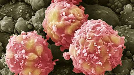 Células tronco são usadas no tratamento de AVC (acidente vascular cerebral) Células tronco são usadas no tratamento de AVC (acidente vascular cerebral)