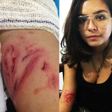 Estudante postou foto com marcas da agressão sofrida durante o protesto Estudante postou foto com marcas da agressão sofrida durante o protesto