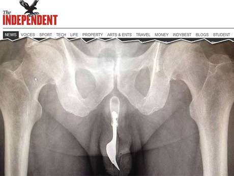 Imagem do raio-x do australiano antes da cirurgia Imagem do raio-x do australiano antes da cirurgia