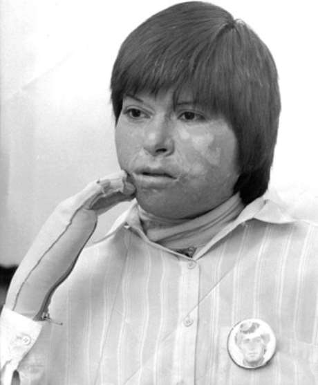 Gentileza: Generación80 Carmen Gloria Quintana sobrevivió a brutal ataque.