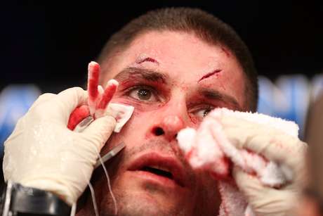 Jeremy Larsen ficou com o rosto ferido em derrota para Andre Fili Jeremy Larsen ficou com o rosto ferido em derrota para Andre Fili