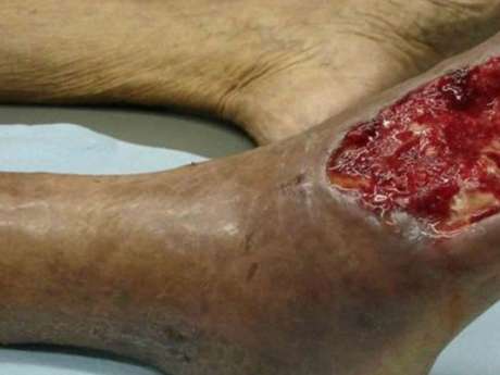 Tomada de Internet / Terra "Krokodil" ha ganado una terrible popularidad al ser responsable de la producción de gravísimos daños en los tejidos, tales como flebitis y gangrena, requiriendo muchas veces la amputación de miembros en usuarios de larga duración.