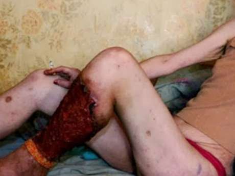 Tomada de Internet / Terra "Krokodil" ha ganado una terrible popularidad al ser responsable de la producción de gravísimos daños en los tejidos, tales como flebitis y gangrena, requiriendo muchas veces la amputación de miembros en usuarios de larga duración.