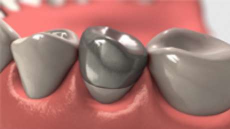 Divulgação Coroas metalocerâmicas