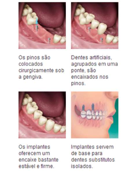 Implantes dentários Implantes dentários