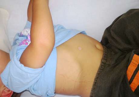 Menino apresentava várias marcas de cigarro pelo corpo em Castro, no Paraná Menino apresentava várias marcas de cigarro pelo corpo em Castro, no Paraná