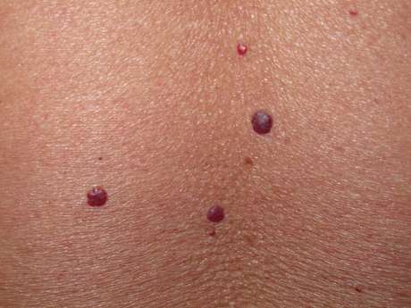 EFE en español <p>Los puntos rojos son pequeñas dilataciones capilares debidas a fallos en el sistema vascular. Es algo parecido a lo que ocurre en las piernas con las varices. </p>