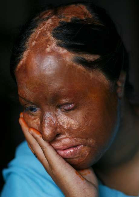 Nalia Raza, 17 anos, foi vítima de violência com ácido em Islamabad, Paquistão em 10 de junho de 2007, tendo de passar por uma cirurgia ocular. Raza foi queimada por ter rejeitado abusos sexuais de seu professor da escola, em uma pequena aldeia no sul do Punjab <p>Nalia Raza, 17 anos, foi vítima de violência com ácido em Islamabad, Paquistão em 10 de junho de 2007, tendo de passar por uma cirurgia ocular. Raza foi queimada por ter rejeitado abusos sexuais de seu professor da escola, em uma pequena aldeia no sul do Punjab</p>