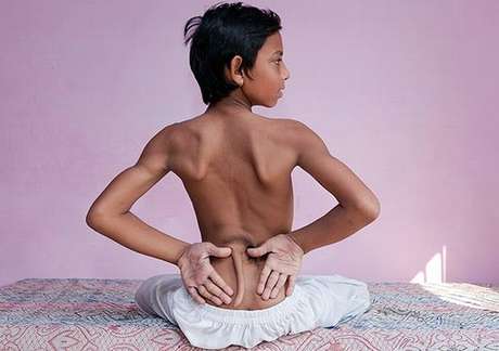 Arshid Ali Khan, de 13 anos, terá que passar por uma cirurgia devido à anomalia. Ele não consegue andar <p>Arshid Ali Khan, de 13 anos, terá que passar por uma cirurgia devido à anomalia. Ele não consegue andar</p>
