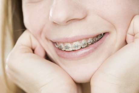 ThinkStock <p>Hay que tener mucho cuidado al limpiar los brackets</p>