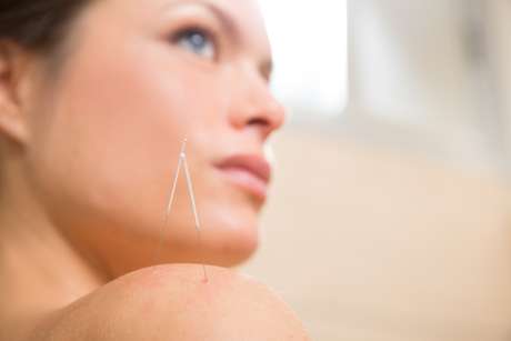 Além de tratar problemas como dores nas costas e ansiedade, a acupuntura também pode ser aplicada em prol da beleza feminina Além de tratar problemas como dores nas costas e ansiedade, a acupuntura também pode ser aplicada em prol da beleza feminina