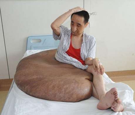 A cirurgia para a remoção do tumor de Yang Jianbin durou 16 horas <p>A cirurgia para a remoção do tumor de Yang Jianbin durou 16 horas</p>