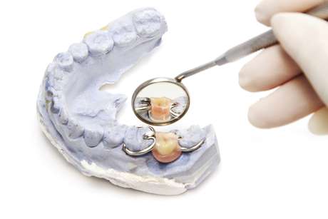 praisaeng / ThinkStock <p>El implante se fusiona con el hueso mandibular, proporcionando un soporte estable para los dientes artificiales</p>