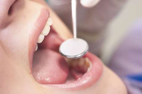 Su dentista le informará si es buen candidato para las carillas u obturaciones con resina compuesta. <p>Su dentista le informará si es buen candidato para las carillas u obturaciones con resina compuesta.</p>