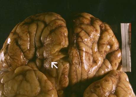 <p>C&eacute;rebro contaminado com a ameba come&ccedil;a a se deteriorar</p>