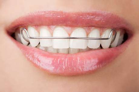 Bruxismo, respiração pela boca e roer a unha podem entortar o dente mesmo com o uso da contenção Bruxismo, respiração pela boca e roer a unha podem entortar o dente mesmo com o uso da contenção