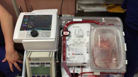 Os transplantes de corações já sem batimento, aparentemente, deram certo em três pacientes (mas, um deles está na UTI) Os transplantes de corações já sem batimento, aparentemente, deram certo em três pacientes (mas, um deles está na UTI)