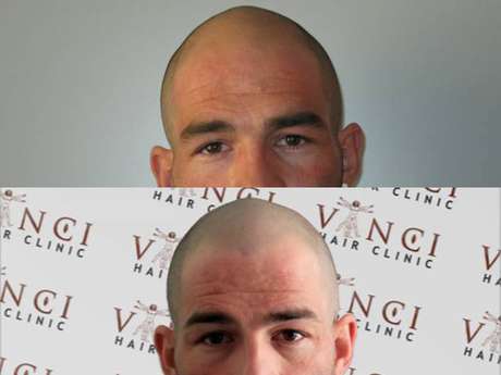 Tatuagem preenche os fol&iacute;culos com tinta permanente 