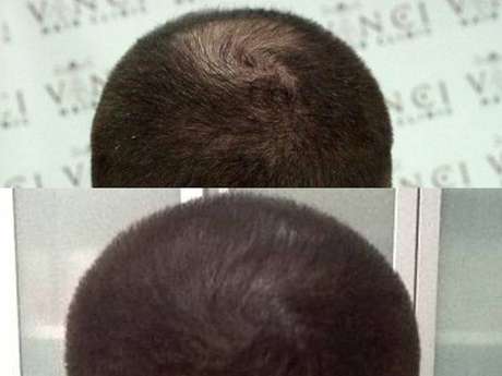 Al&eacute;m de salvar os carecas, a t&eacute;cnica tamb&eacute;m &eacute; usada para disfar&ccedil;ar falhas 