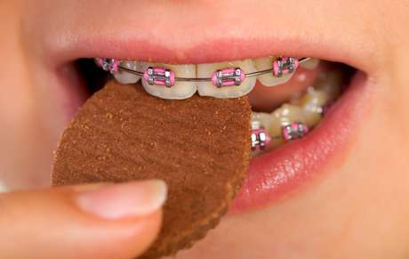 Comer alimentos duros pode quebrar os bráquetes: tenha cuidado Comer alimentos duros pode quebrar os bráquetes: tenha cuidado