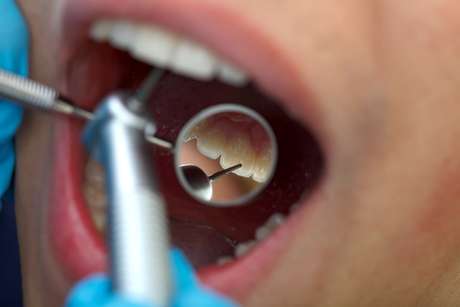Alguns escurecimentos dentais são causados por conta da forma com o tratamento foi feito, falhando em alguns pontos