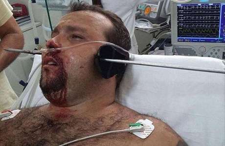 Homem deu entrada em hospital com barra de metal atravessada na cabeça.