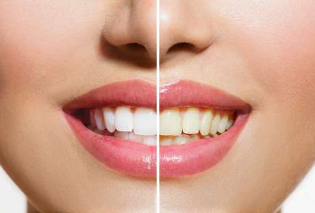 Apesar de ser um problema apenas estético, o escurecimento dos dentes é uma das maiores reclamações nos consultórios odontológicos Apesar de ser um problema apenas estético, o escurecimento dos dentes é uma das maiores reclamações nos consultórios odontológicos