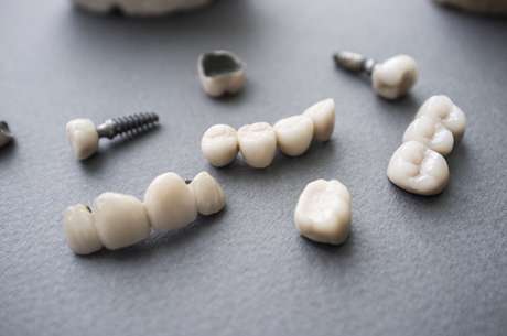 Escolher o método errado de reparo pode piorar a situação e ocasionar diversos outros problemas dentários. Por isso, conhecê-los é muito importante. Escolher o método errado de reparo pode piorar a situação e ocasionar diversos outros problemas dentários. Por isso, conhecê-los é muito importante.