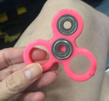 Operan a niña por tragarse pieza de Fidget Spinner