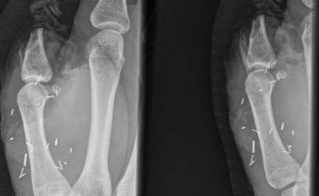 Cirurgiões tentaram reimplantar o polegar decepado duas vezes