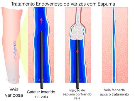 Qual é o melhor tratamento para edema macular