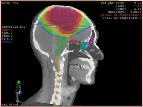 Médicos retiram 'maior tumor do mundo' em paciente na Índia