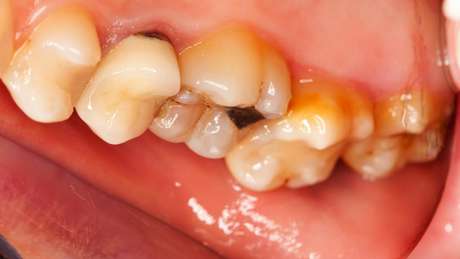Erosão dentária pode causar perda de dentes