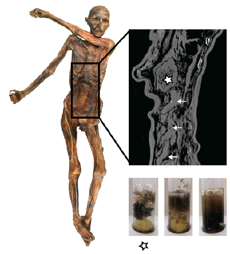 Imagem do trato digestivo do Homem de Gelo - estômago só foi localizado em exames 18 anos após a descoberta da múmia Imagem do trato digestivo do Homem de Gelo - estômago só foi localizado em exames 18 anos após a descoberta da múmia