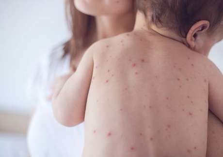 the measles
