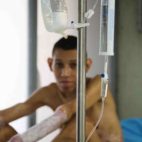 Ángel sofreu queimaduras há 5 anos. Na Venezuela, em vez de tratamento no hospital, ele contraiu infecções. Agora, está sendo tratado na Colômbia