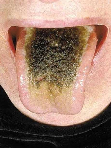 Em 2006, publicação acadêmica publicou caso de fumante que viveu com doença por vários anos | Crédito: The New England Journal of Medicine Em 2006, publicação acadêmica publicou caso de fumante que viveu com doença por vários anos | Crédito: The New England Journal of Medicine