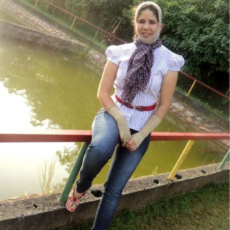 Em 9 anos, Alexandra fez 35 cirurgias para minimizar as sequelas das queimaduras Em 9 anos, Alexandra fez 35 cirurgias para minimizar as sequelas das queimaduras