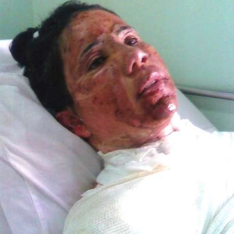 Alexandra passou por três hospitais nos 21 dias em que ficou internada após a queimadura Alexandra passou por três hospitais nos 21 dias em que ficou internada após a queimadura
